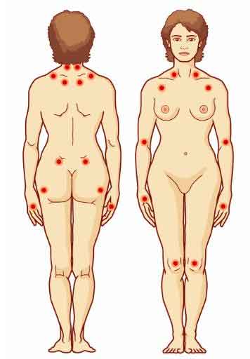 Fibromialgia: conceptos fundamentales